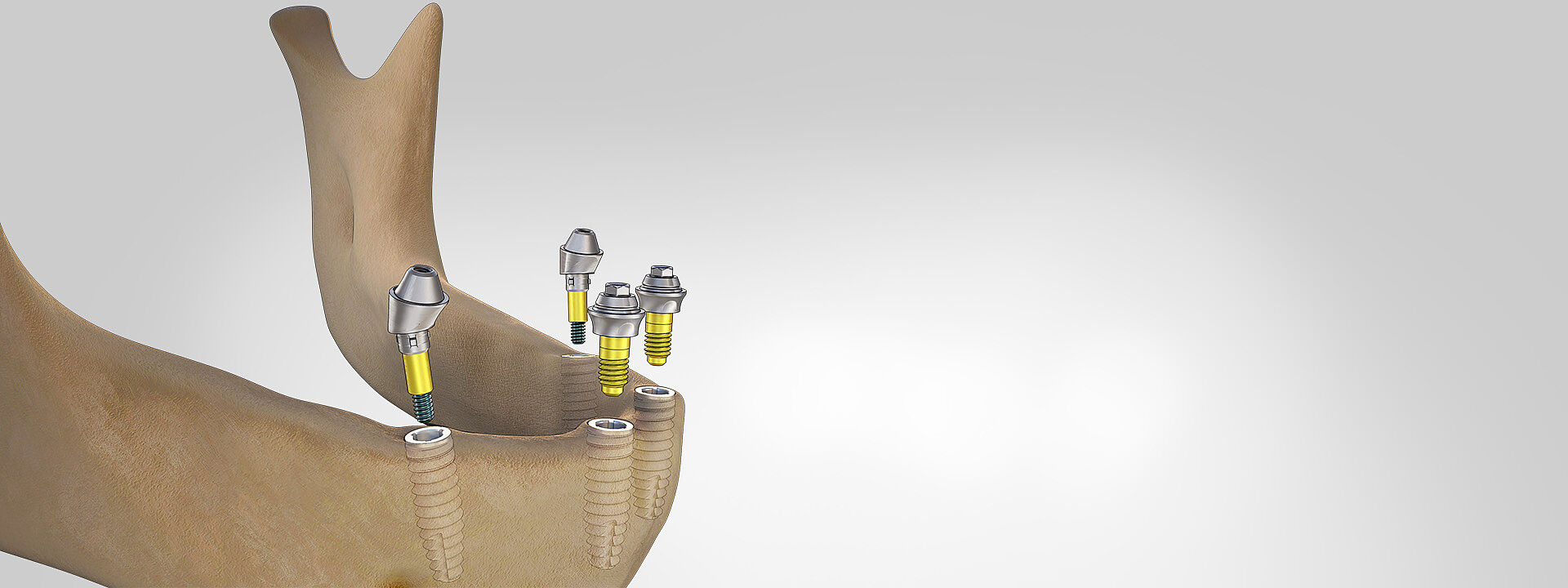 El sistema Multi-unit para la restauración de maxilares edéntulos