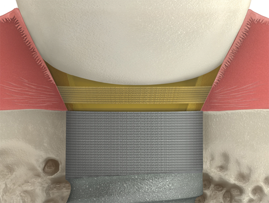 BioHorizons Tapered Internal Implant detailed view
