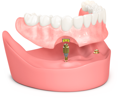Modelo BioHorizons OD Secure BioHorizons OD Secure Model