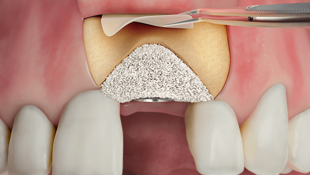 Aumento general de la cresta alveolar