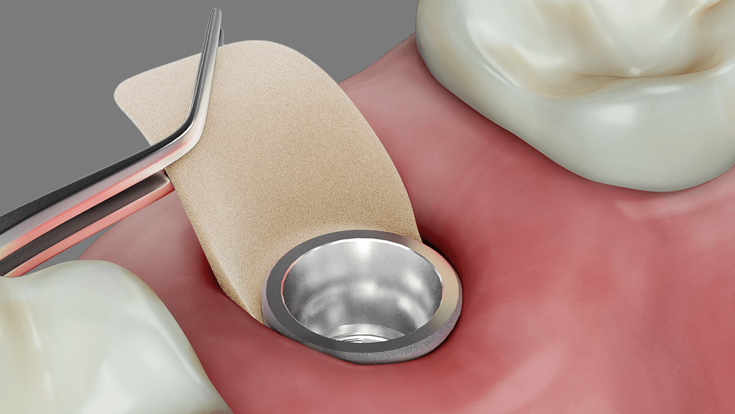 Engrosamiento del tejido alrededor de los implantes y de las piezas dentales con la técnica de bolsillo